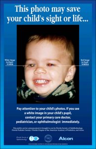 Retinoblastoma Photo