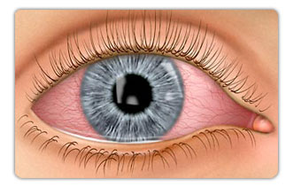Eye Diseases: Fuchs’ Endothelial Dystrophy