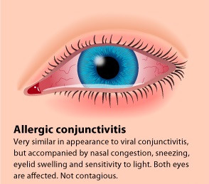 Allergic Conjunctivitis