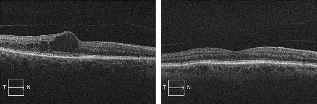 Diabetic Macular Edema (DME)