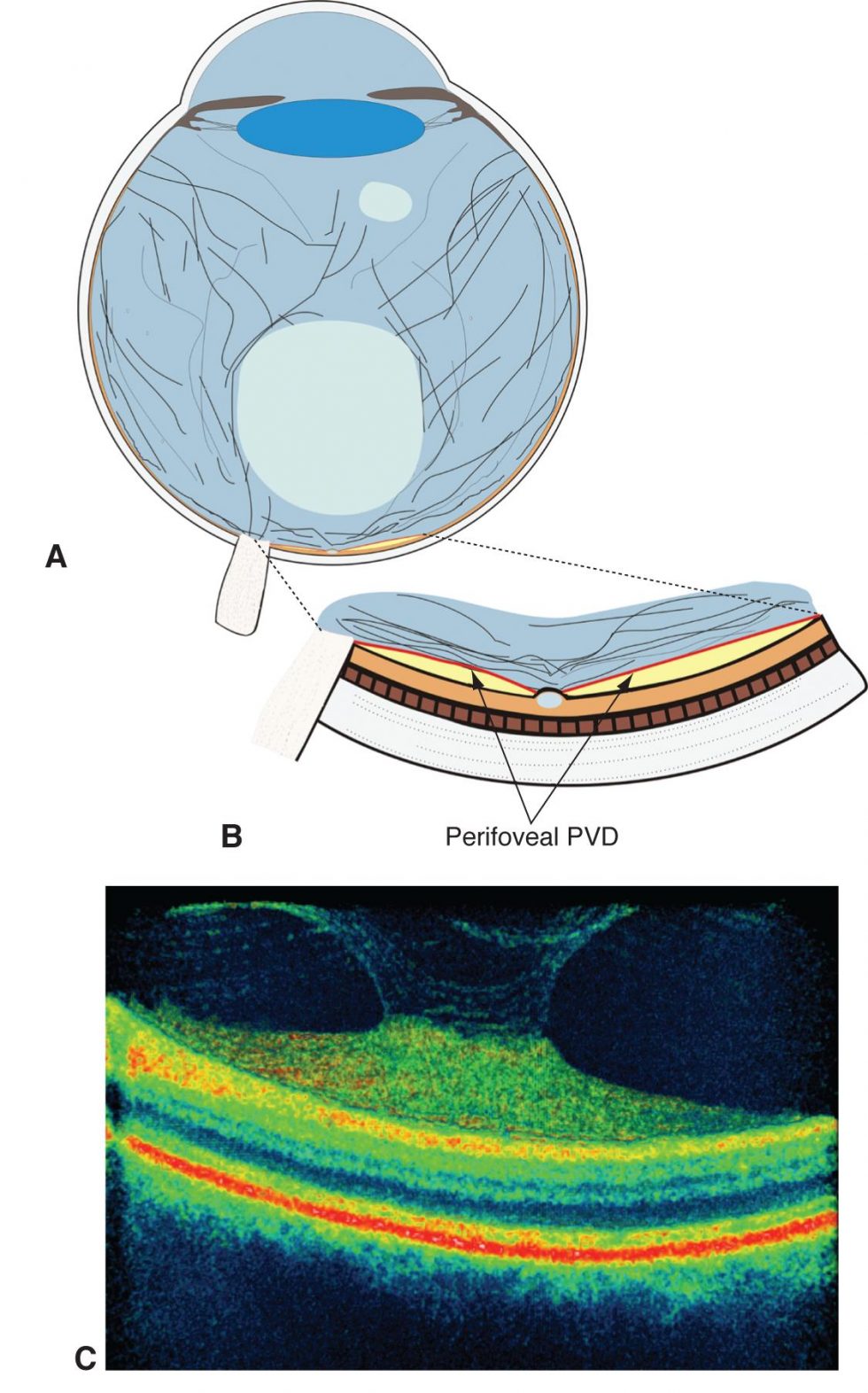 Flashes and Floaters Eye Care Services North Houston Eye Care