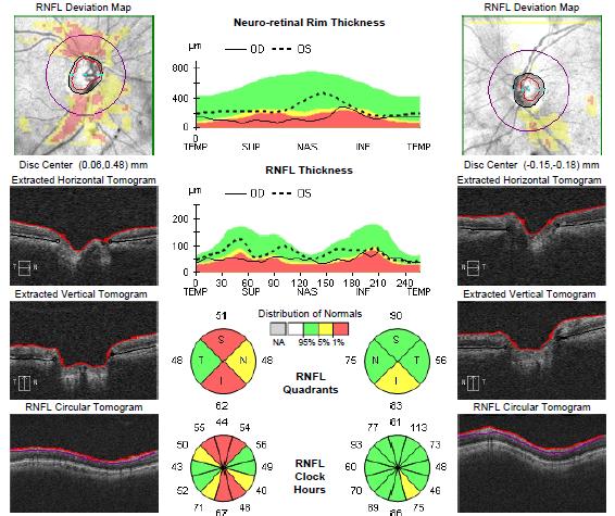 Glaucoma