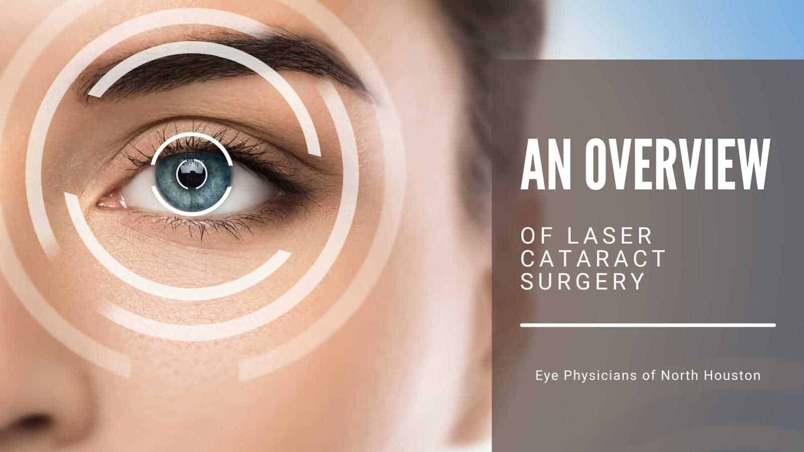 laser cataract surgery