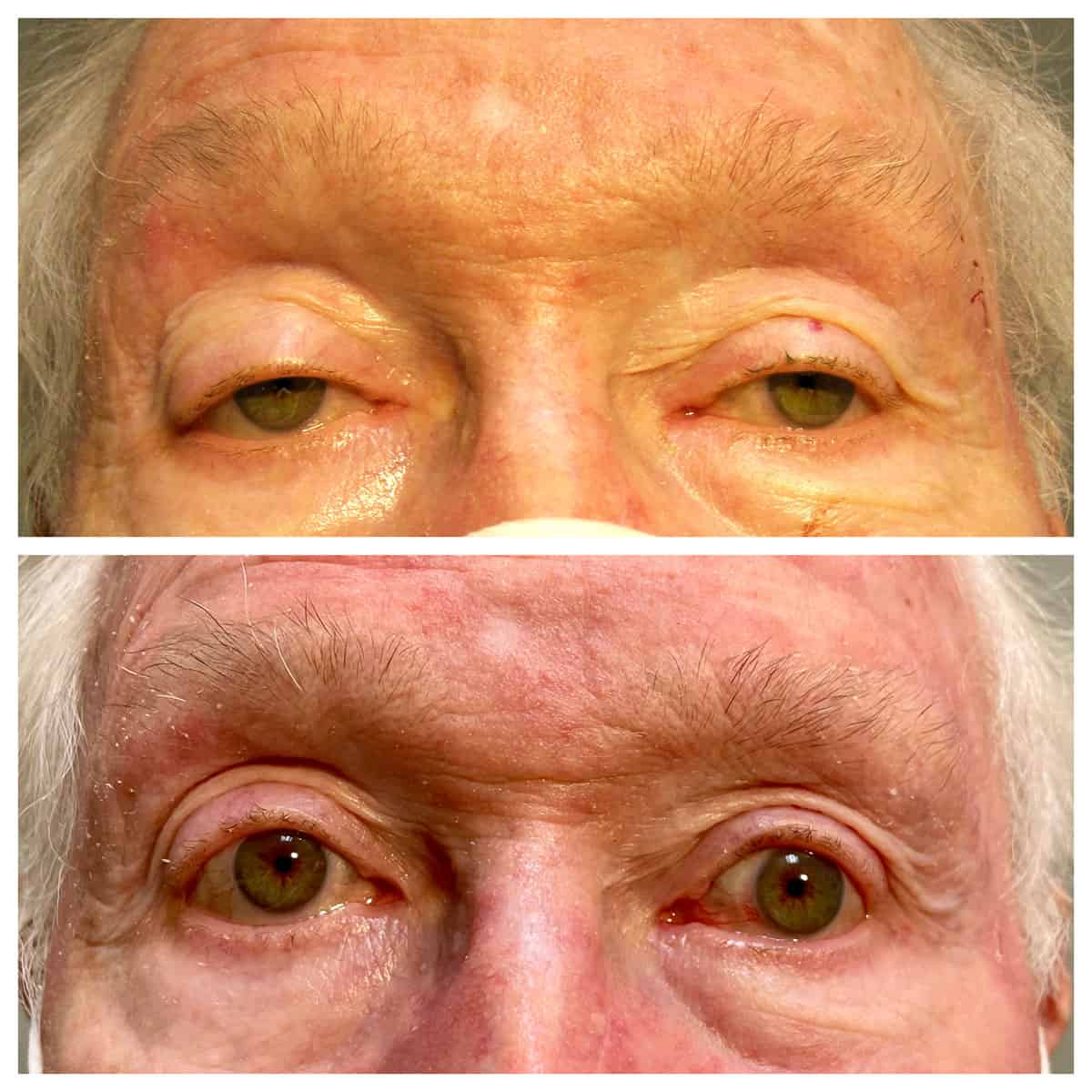 Ptosis Repair - Before and After Ptosis Repair - Before and After