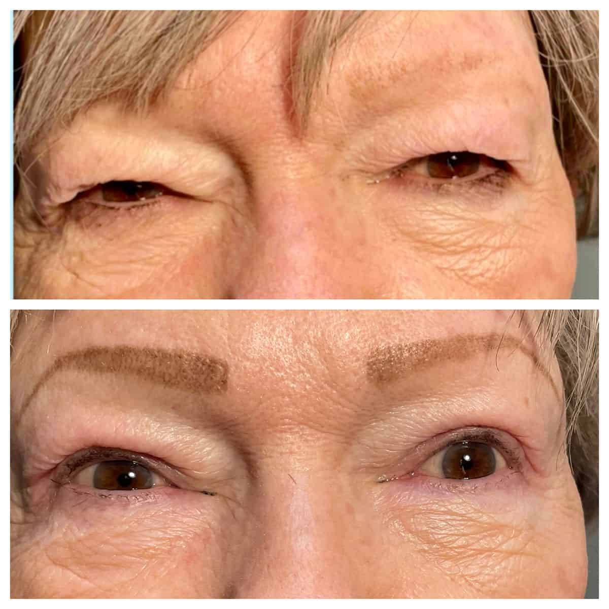 Upper Eyelid Blepharoplasty - Before and After Upper Eyelid Blepharoplasty - Before and After