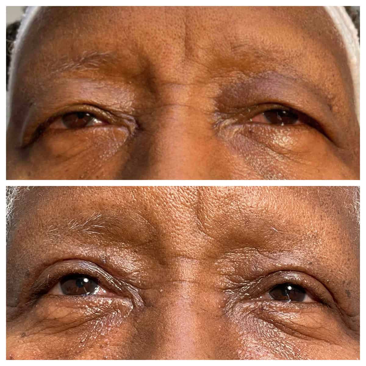 Upper Eyelid Blepharoplasty - Before and After Upper Eyelid Blepharoplasty - Before and After