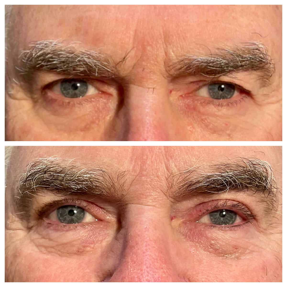 Upper Eyelid Blepharoplasty - Before and After Upper Eyelid Blepharoplasty - Before and After