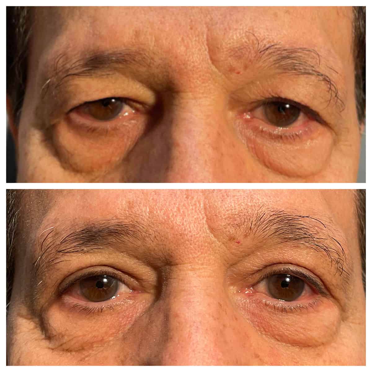 Upper Eyelid Blepharoplasty - Before and After Upper Eyelid Blepharoplasty - Before and After