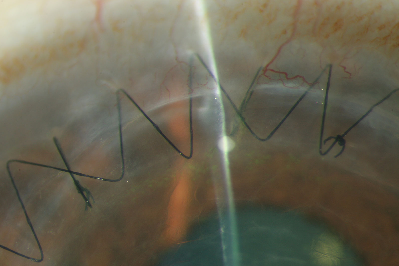 Surgery: Corneal Transplants Surgery: Corneal Transplants