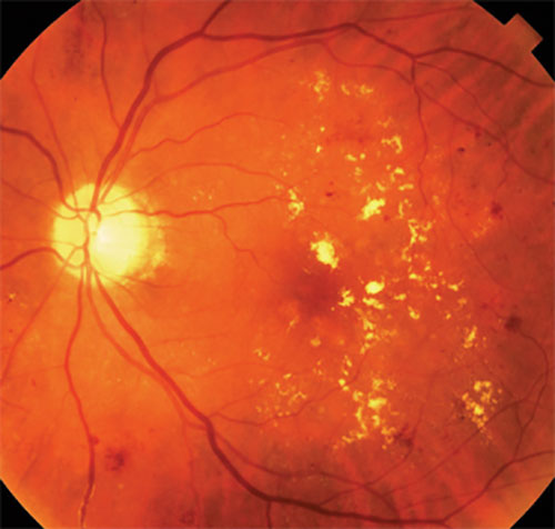 Diabetic Macular Edema