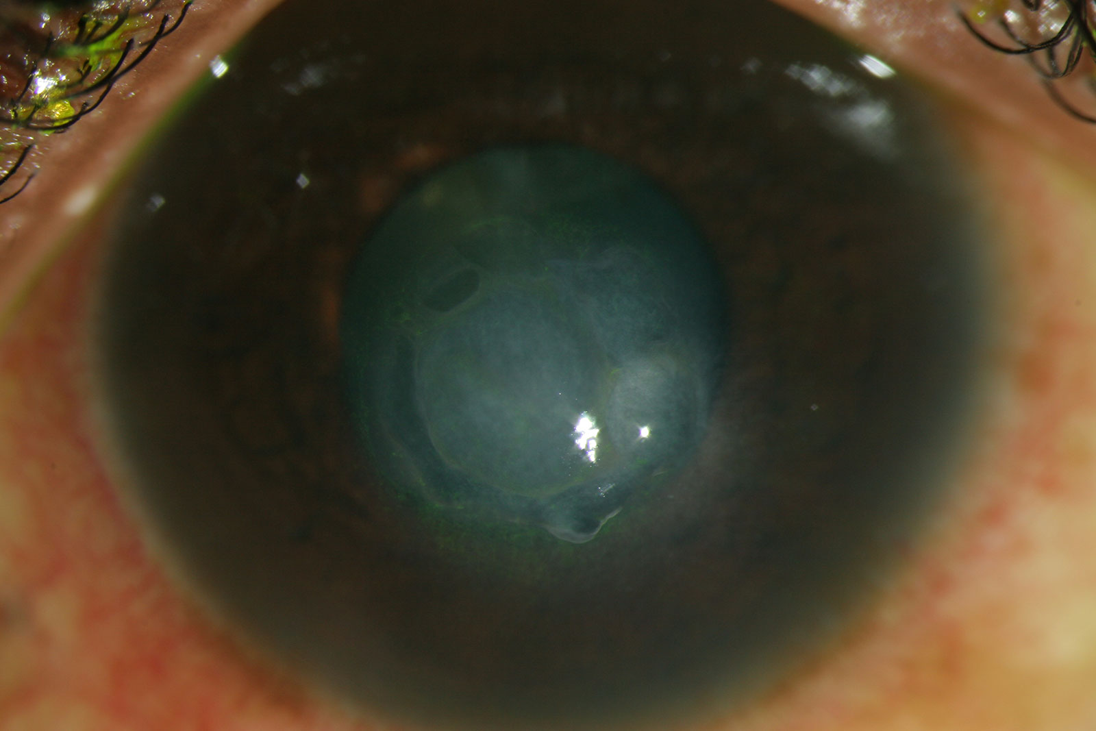 Structural: Keratoconus, Fuchs’ endothelial dystrophy Structural: Keratoconus, Fuchs’ endothelial dystrophy