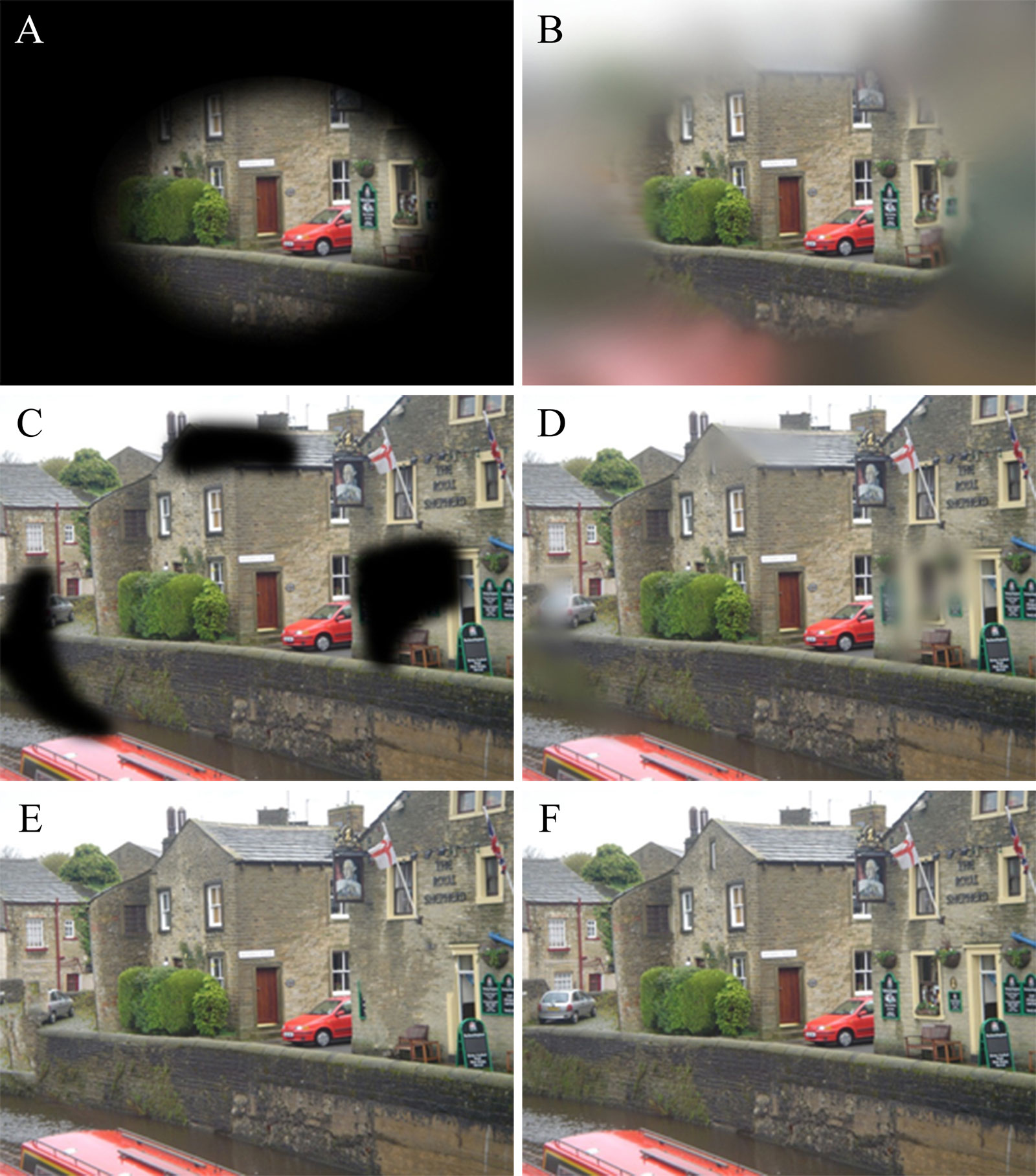 Glaucoma Examples Glaucoma Examples