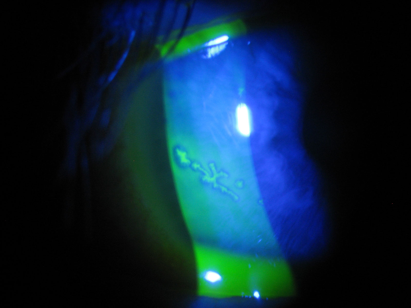 Infectious: Herpes simplex virus & Herpes zoster virus Infectious: Herpes simplex virus & Herpes zoster virus