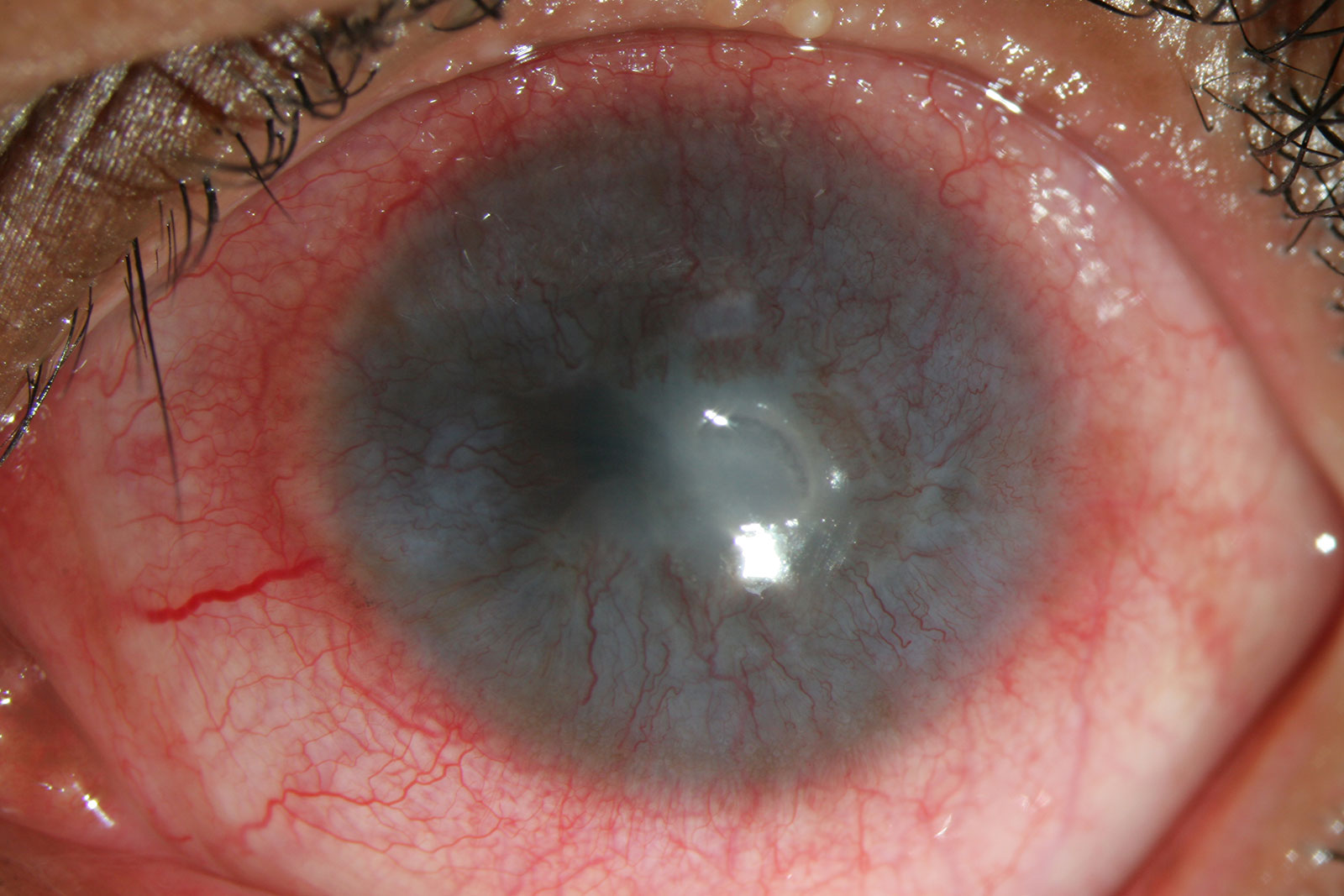 Inflammatory: Interstitial Keratitis Inflammatory: Interstitial Keratitis