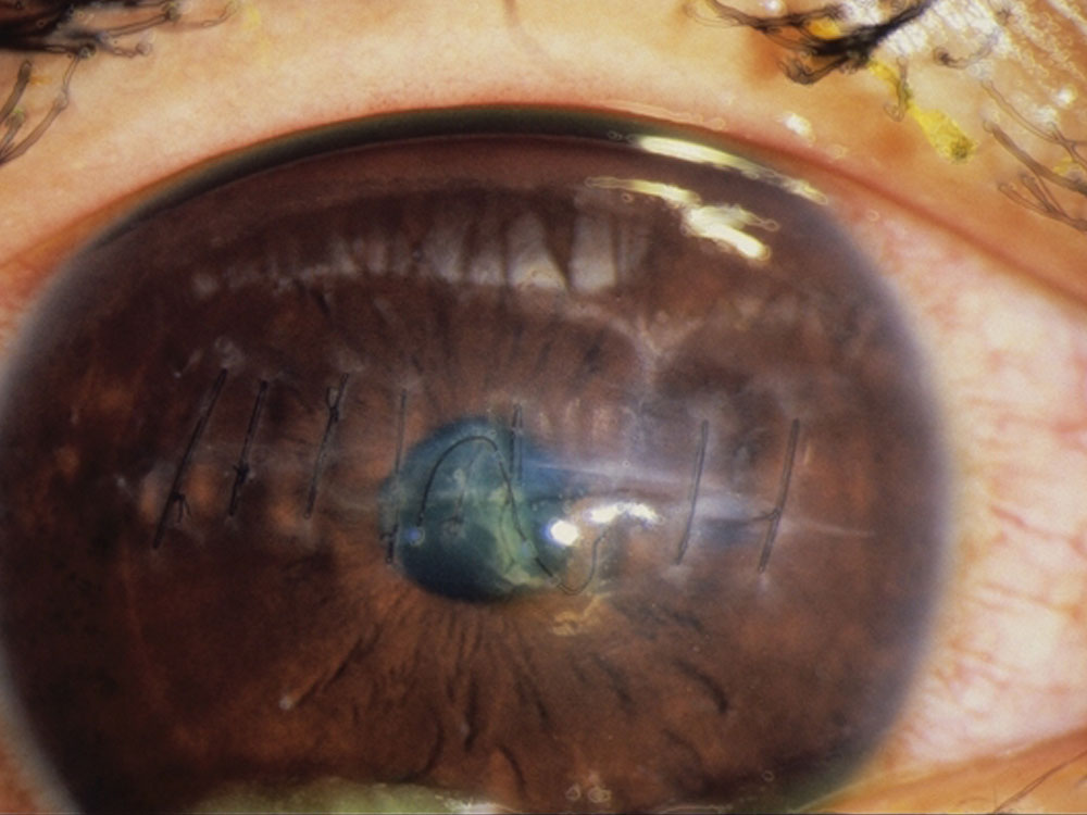 Traumatic: Corneal Laceration Traumatic: Corneal Laceration