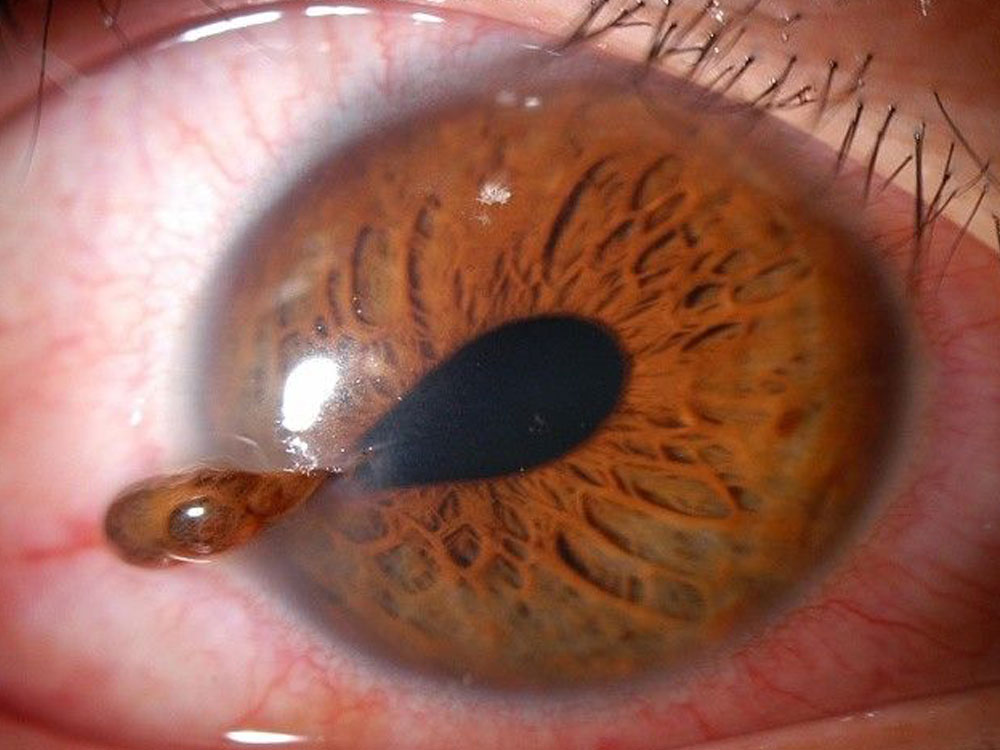 Traumatic: Corneal Laceration Traumatic: Corneal Laceration